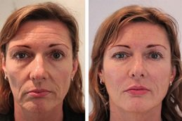 Best Skin Booster surgeons