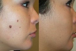 Best Skin Tag Removal surgeons