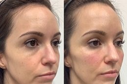 Best Skin Tightening and Contouring in riyadh