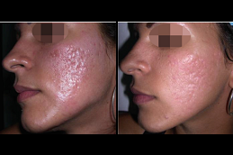 Best Subcision Treatment for Acne Scars clinic in riyadh