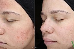 Best Subcision Treatment for Acne Scars in riyadh