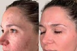 Best Wrinkle Smoothing clinic in riyadh