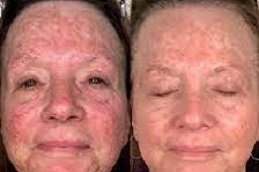 Best Wrinkle Smoothing cost in Riyadh