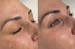 Dermamelan Peel in Riyadh