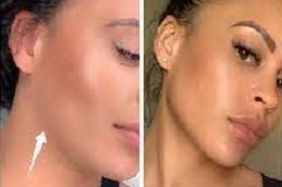 Jawline Fillers Injections cost in riyadh