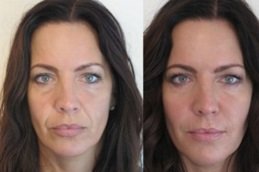 Jawline Fillers Injections in Riyadh