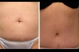 Liposuction surgery clinic in Jeddah