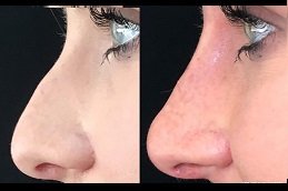 Liquid Rhinoplasty clinic in riyadh