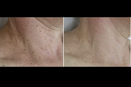 Skin Tag Removal clinic in riyadh