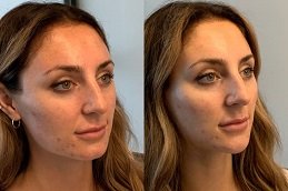 Skin Tightening and Contouring in Riyadh