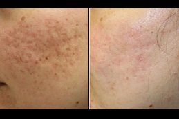Subcision Treatment for Acne Scars in Riyadh