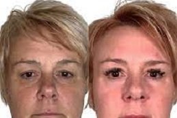 Wrinkle Smoothing clinic in riyadh