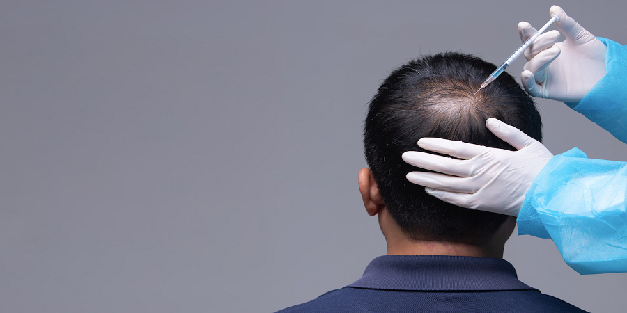 Is PRP Treatment a Permanent solution for hair loss?
