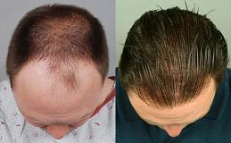 Hair Transplant in Buraydah & Al Qassim