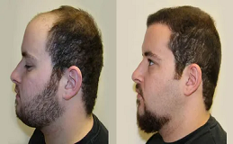 Hair Transplant in Buraydah & Al Qassim