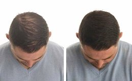 Hybrid Hair Transplant in Riyadh and Saudi Arabia