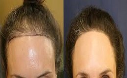 Hybrid Hair Transplant in Riyadh and Saudi Arabia