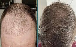 Hybrid Hair Transplant in Riyadh and Saudi Arabia