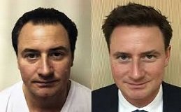 Hybrid Hair Transplant in Riyadh and Saudi Arabia