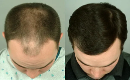 Hybrid Hair Transplant in Riyadh and Saudi Arabia