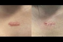 Hypertrophic Scars Treatment in Riyadh
