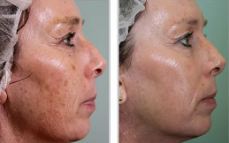 Laser Photo Rejuvenation in Riyadh and Saudi Arabia