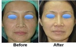 Laser Photo Rejuvenation in Riyadh and Saudi Arabia