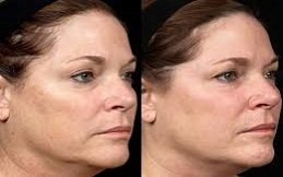 Laser Photo Rejuvenation in Riyadh and Saudi Arabia