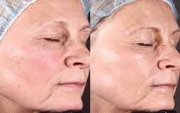 Laser Photo Rejuvenation in Riyadh and Saudi Arabia