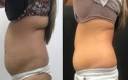 CoolSculpting Fat Freezing in Riyadh & Saudi Arabia