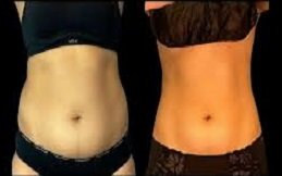 CoolSculpting Fat Freezing in Riyadh & Saudi Arabia