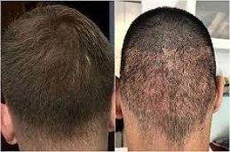 Scarless Hair Transplant in Riyadh