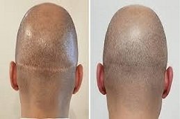 Scarless Hair Transplant in Riyadh