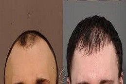 Scarless Hair Transplant in Riyadh