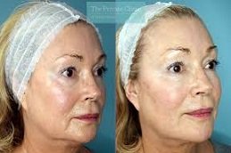 8 Point Facelift with Juvederm in Riyadh & Saudi Arabia