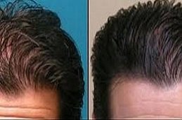 ACell PRP Therapy Hair Loss in Riyadh & Saudi Arabia