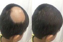 Alopecia Areata Treatment in Riyadh & Saudi Arabia