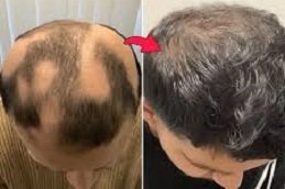 Alopecia Areata Treatment in Riyadh & Saudi Arabia