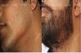 Alopecia Areata Treatment in Riyadh & Saudi Arabia