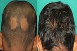 Alopecia Areata Treatment in Riyadh & Saudi Arabia