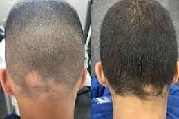 Alopecia Areata Treatment in Riyadh & Saudi Arabia