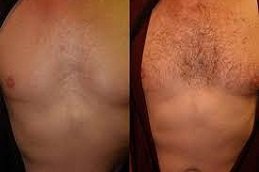 Body Hair Transplant in Riyadh and Saudi Arabia