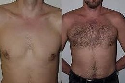 Body Hair Transplant in Riyadh and Saudi Arabia