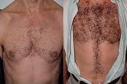 Body Hair Transplant in Riyadh and Saudi Arabia