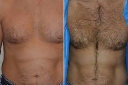 Body Hair Transplant in Riyadh and Saudi Arabia