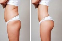 Butt body fillers in Riyadh & Saudi Arabia