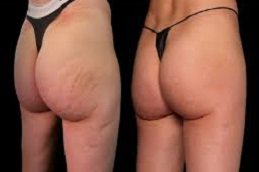 Butt body fillers in Riyadh & Saudi Arabia