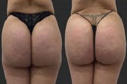 Butt body fillers in Riyadh & Saudi Arabia