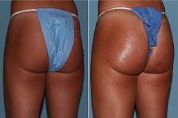 Butt body fillers in Riyadh & Saudi Arabia