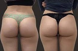 Butt body fillers in Riyadh & Saudi Arabia